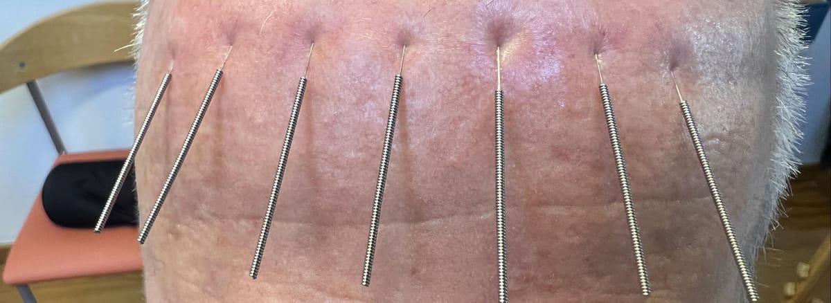 14 WHO Scalp Acupuncture