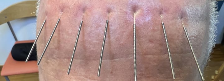 14 WHO Scalp Acupuncture